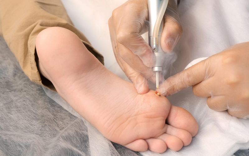 Pied: un podologue peut-il soigner une verrue plantaire?